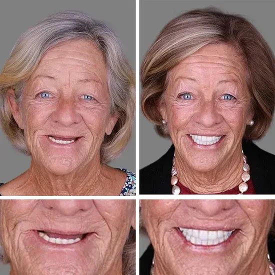 🏆Ends Today: 70% OFF! 🏆2026 Bestselling Product🦷 Fit for a Fresh Smile, Say Goodbye to Wearing Discomfort!🌎