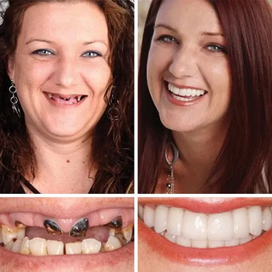 🏆Ends Today: 70% OFF! 🏆2026 Bestselling Product🦷 Fit for a Fresh Smile, Say Goodbye to Wearing Discomfort!🌎
