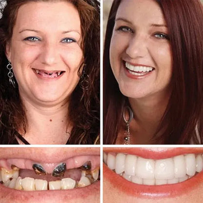 🏆Ends Today: 70% OFF! 🏆2026 Bestselling Product🦷 Fit for a Fresh Smile, Say Goodbye to Wearing Discomfort!🌎