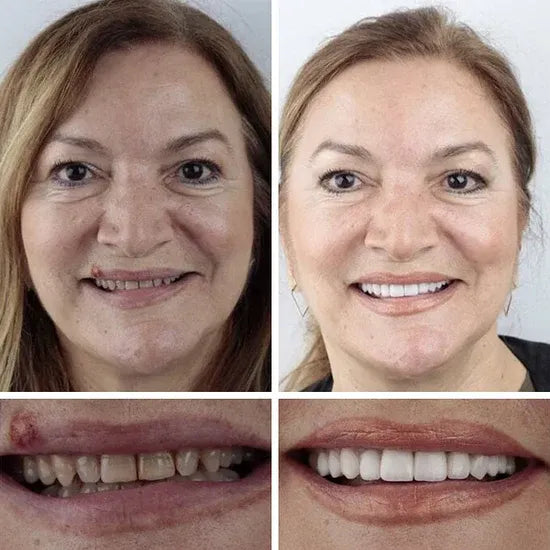 🏆Ends Today: 70% OFF! 🏆2026 Bestselling Product🦷 Fit for a Fresh Smile, Say Goodbye to Wearing Discomfort!🌎
